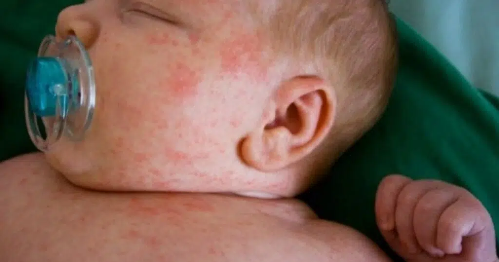 Bebé con alergia a la proteína de la leche